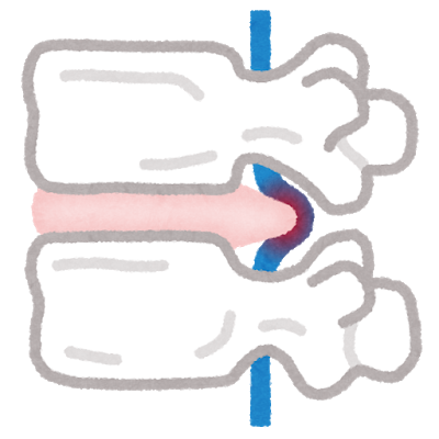 腰部椎間板ヘルニア
