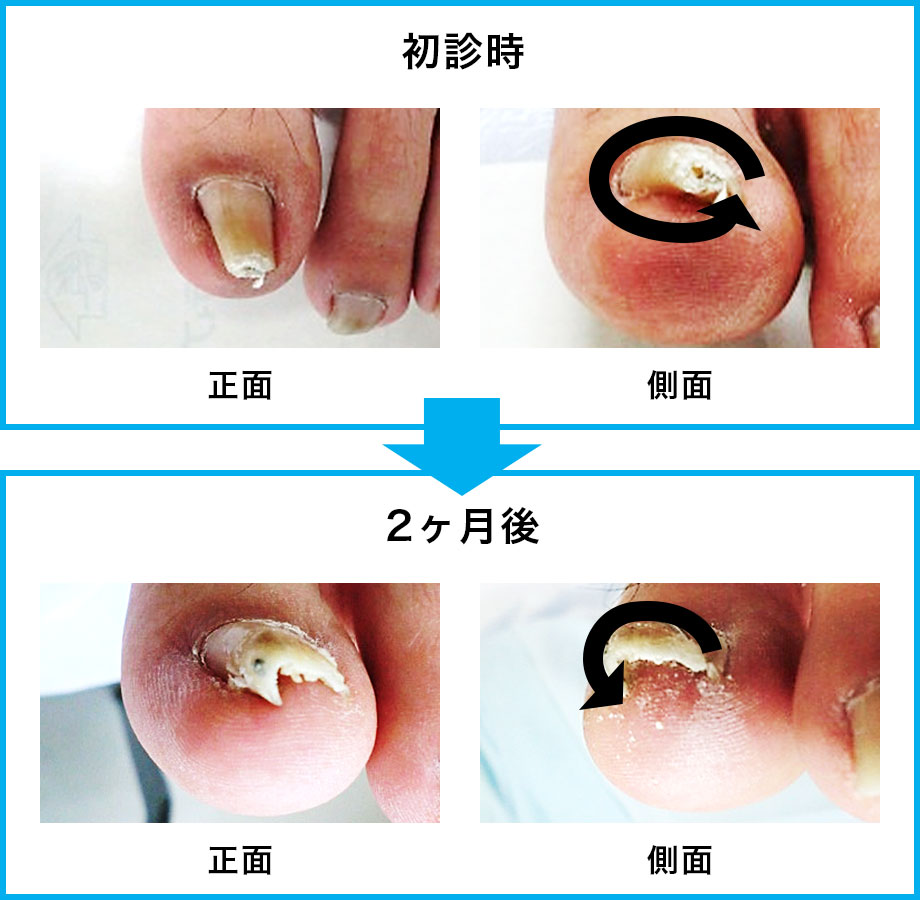 巻き爪